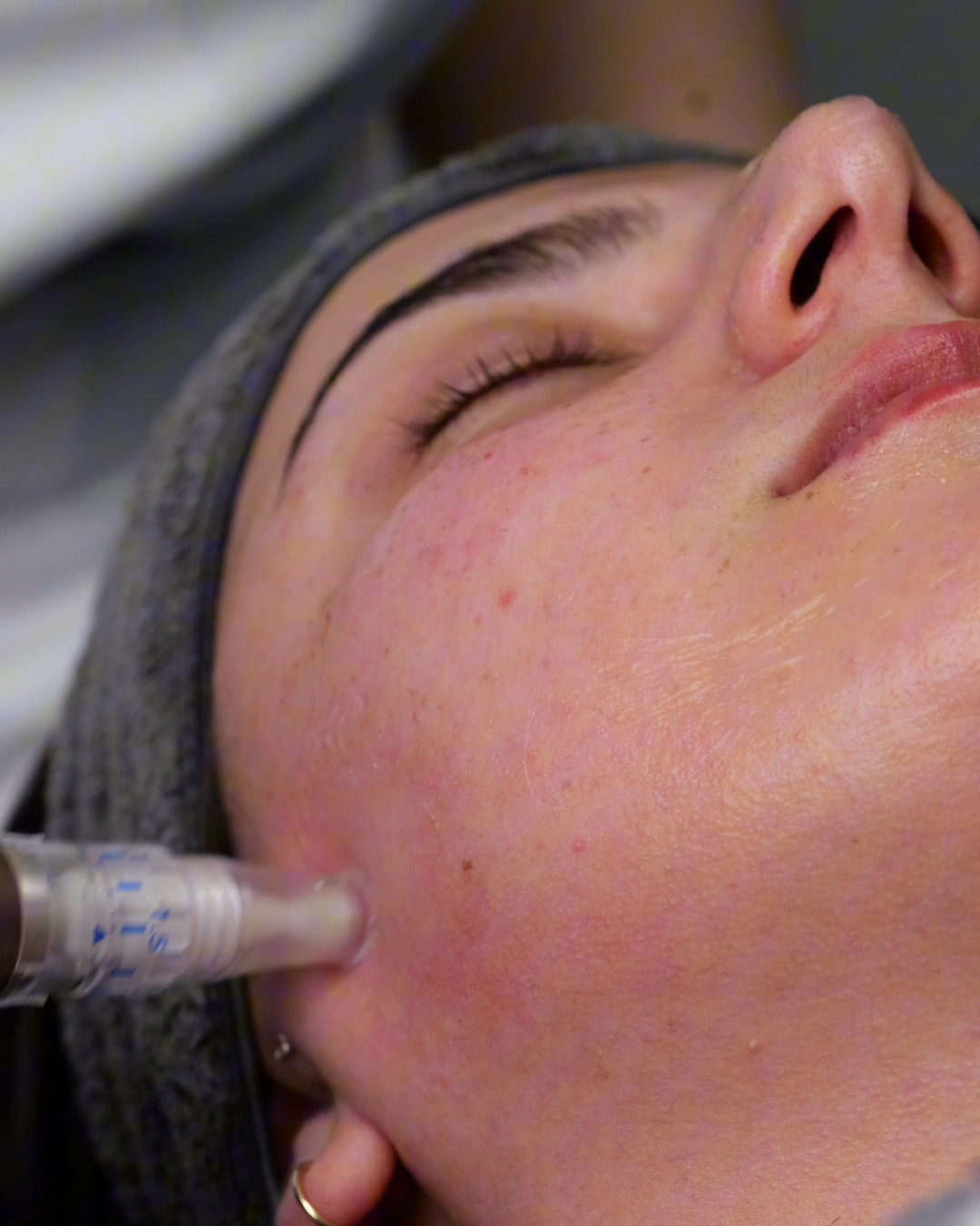 Microneedling-behandling med mikronålspenna mot käken